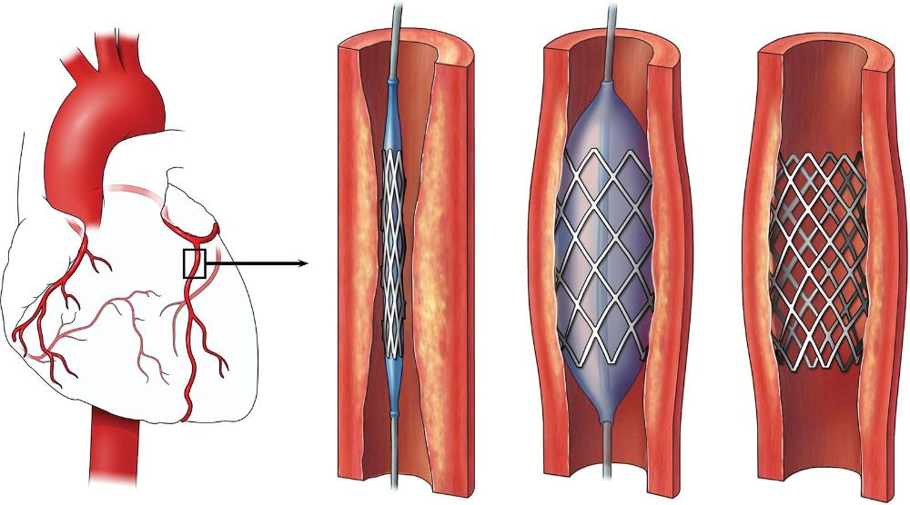 Angioplasty & Stent