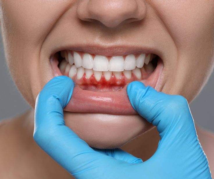 Gum Disease Treatment