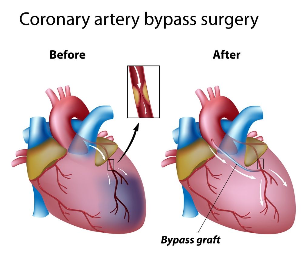 CABG – Coronary Artery Bypass Surgery