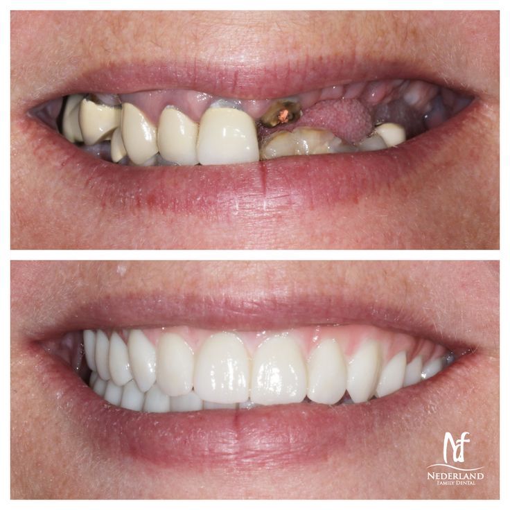 Full Mouth Rehabilitation