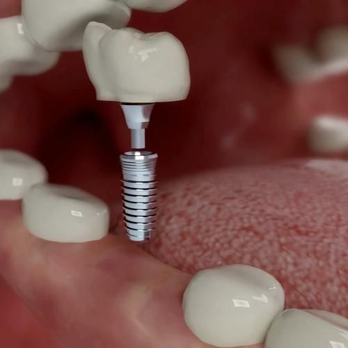 Dental Implants