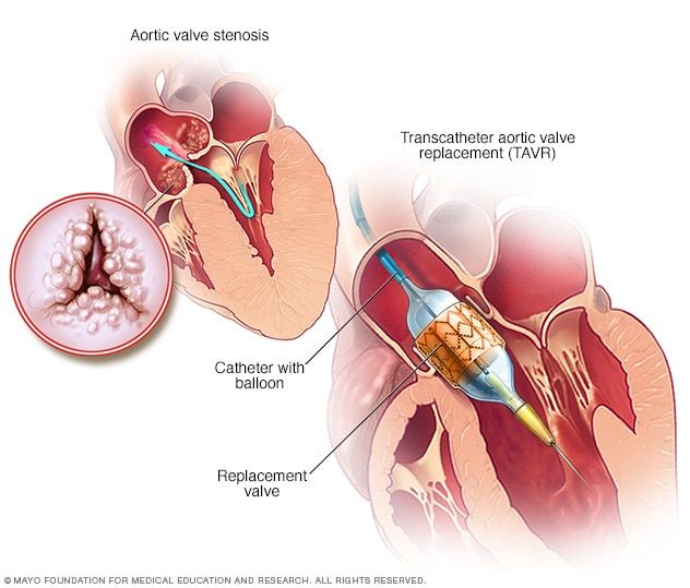 Heart Valves Replacement Surgery