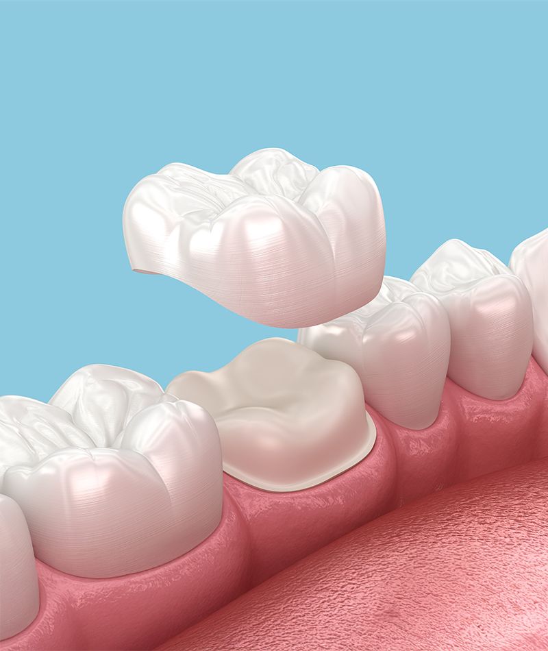 Dental Crowns & Bridges