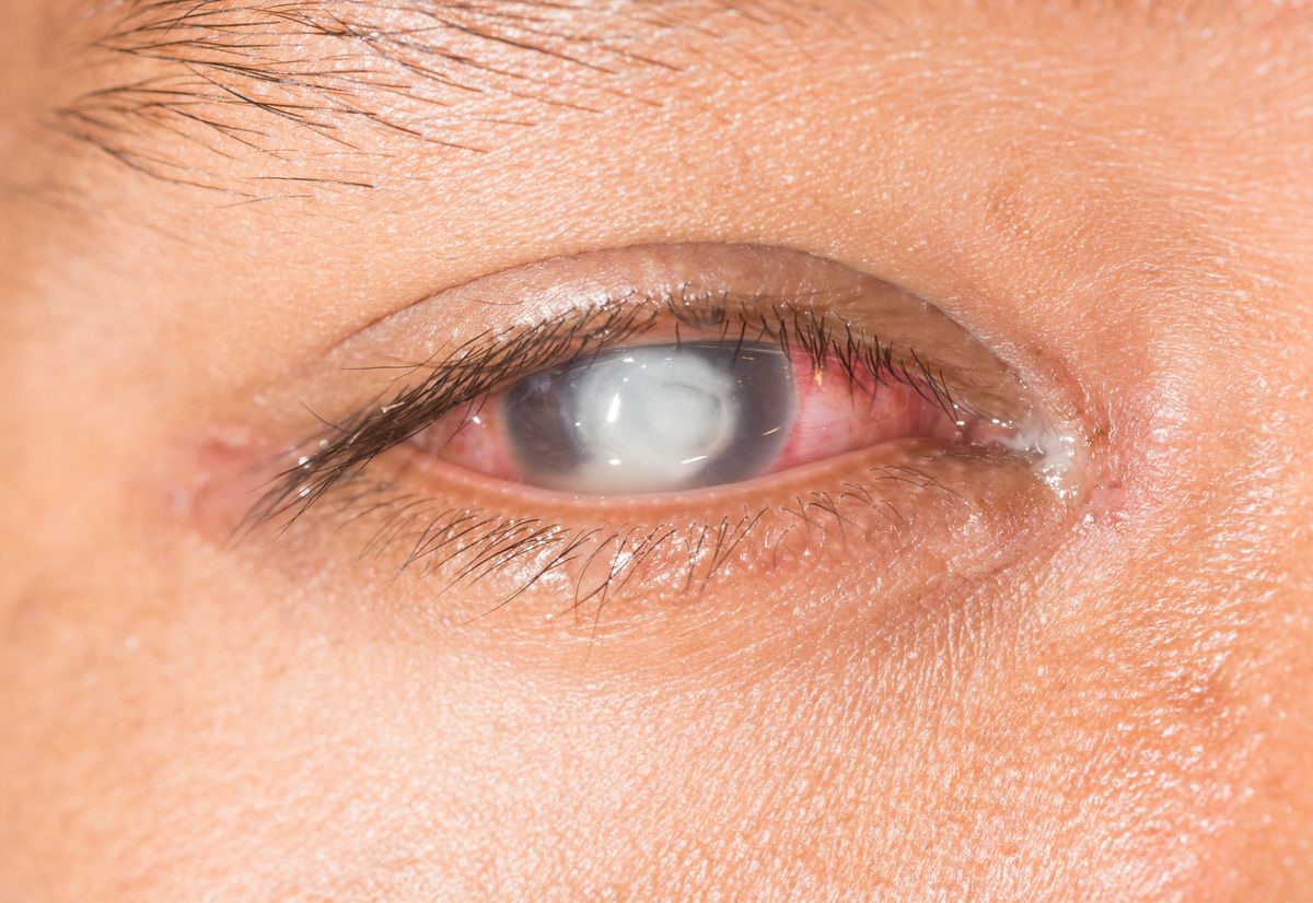 Cornea Treatments and Corneal Transplantation Procedures