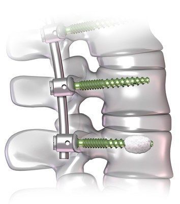 Minimally Invasive Spine Surgery