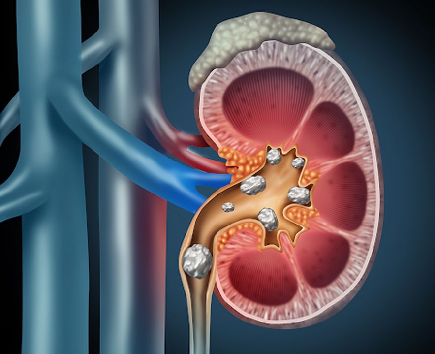 Kidney Stones Treatment