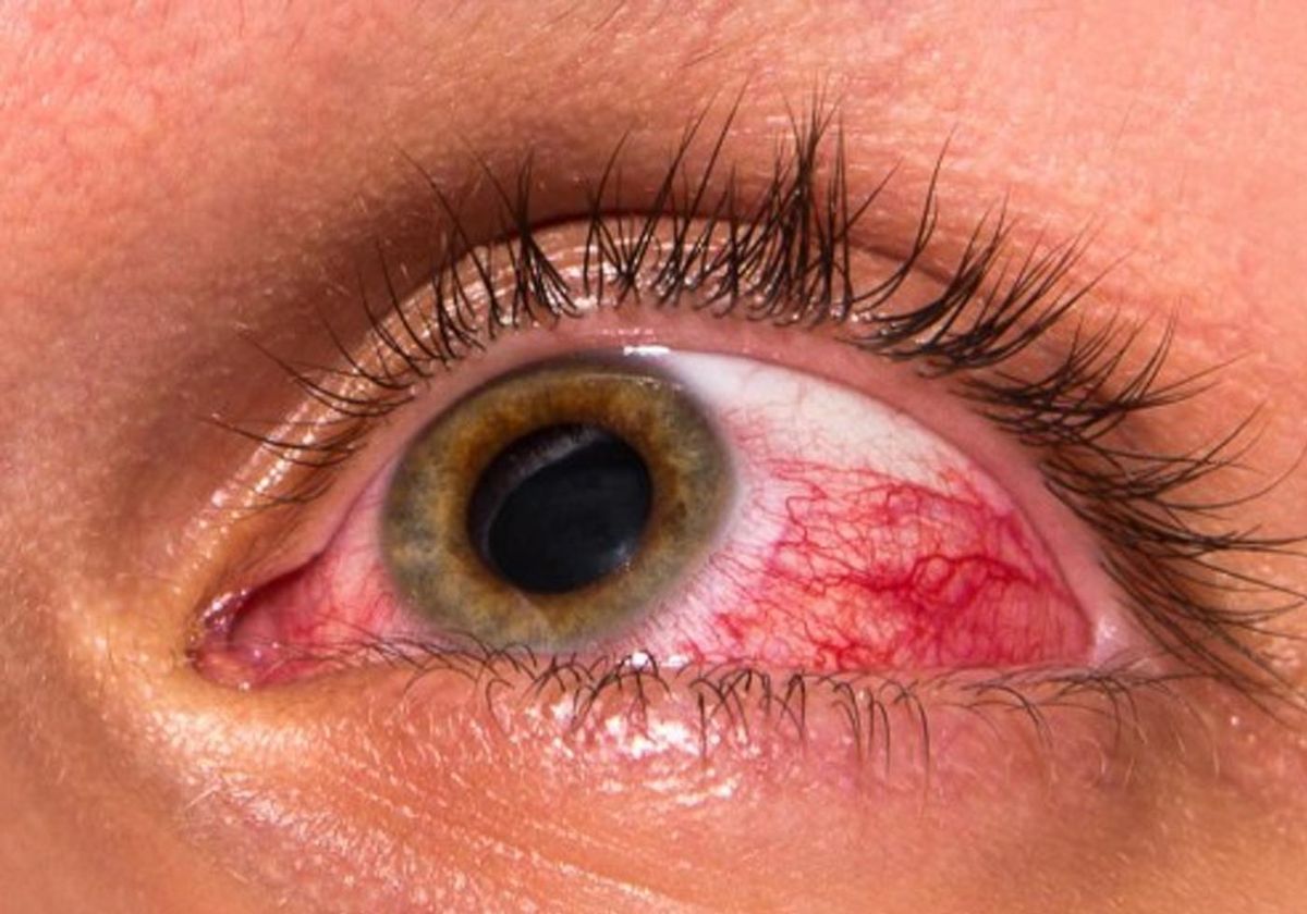 Glaucoma Treatments