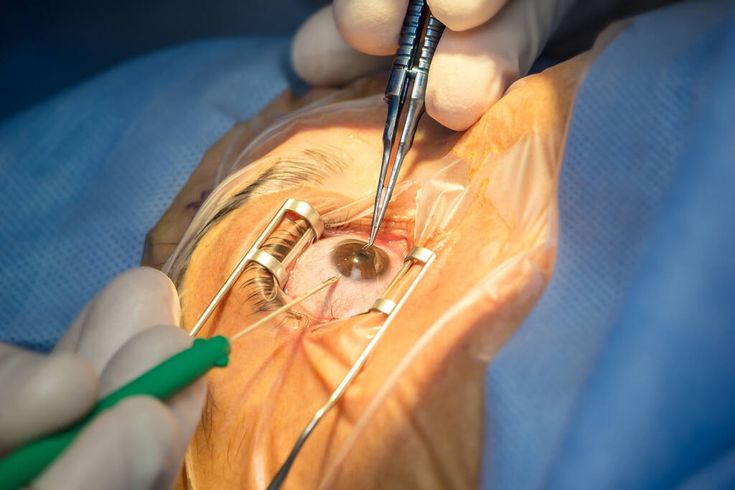 Cataract Surgery