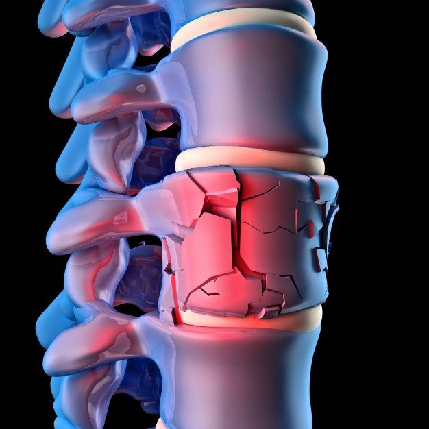 Spinal Fractures and Injuries