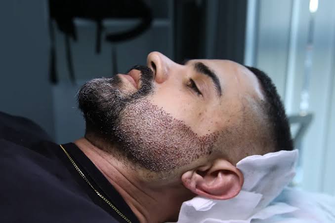 Beard Transplant