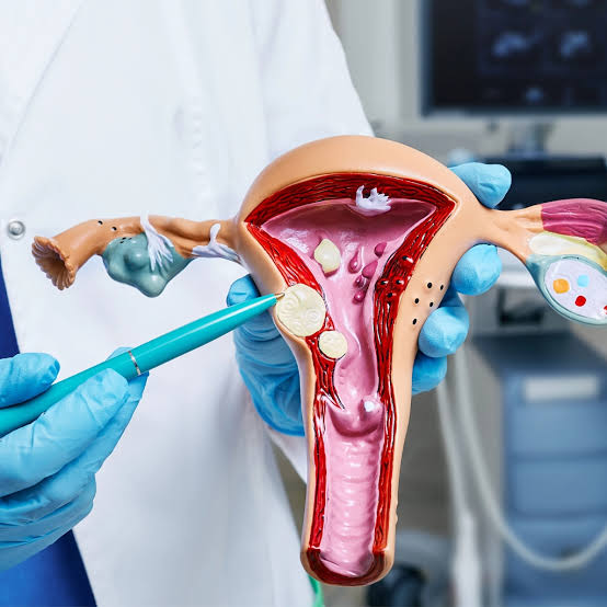 Fibroid Treatment