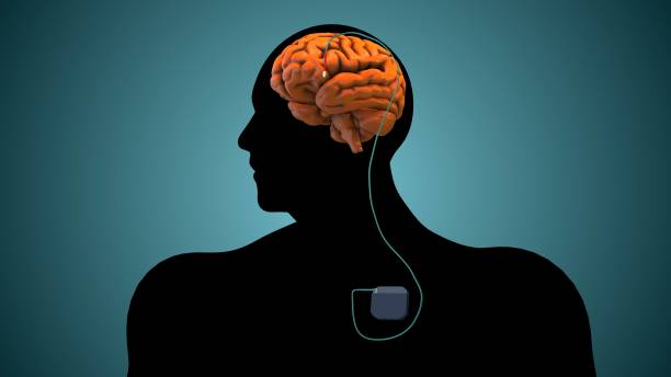Deep Brain Stimulation (DBS)